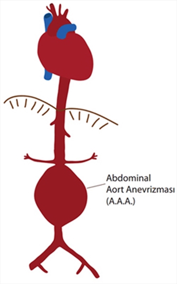 Aort Hastalıklarında Erken Teşhis Hayat Kurtarıyor
