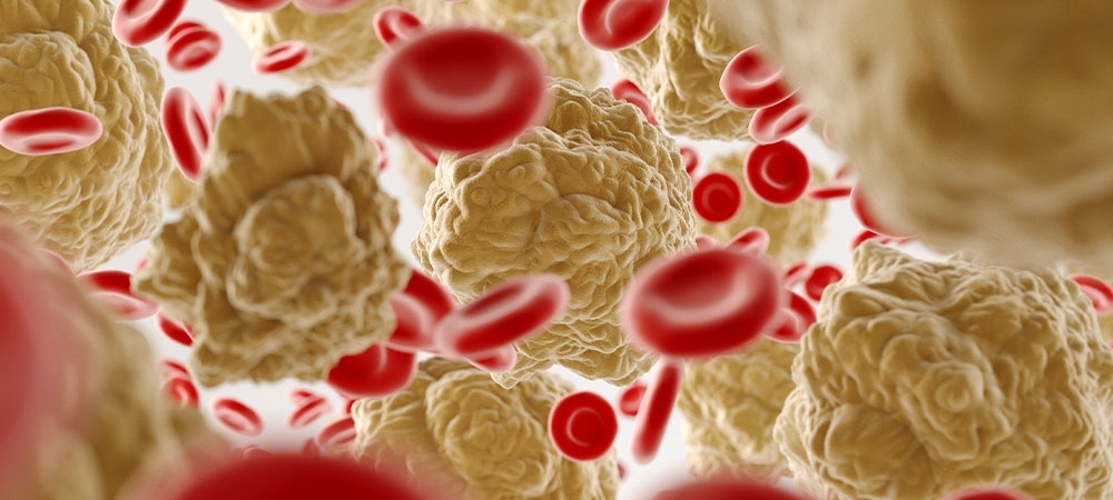 LDL kolesterol yüksekliği/düşüklüğü ne anlama gelir? 