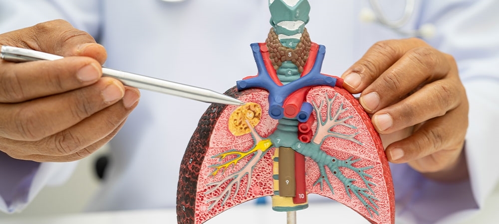 Bronşektazi belirtileri nelerdir? Bronşektazi geçer mi?