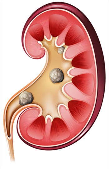 Böbrek Taşına Boyutuna Göre Tedavi