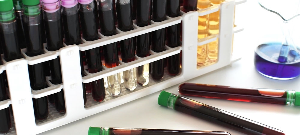 EGFR değeri kaç olmalı? EGFR ne zaman tehlikeli?