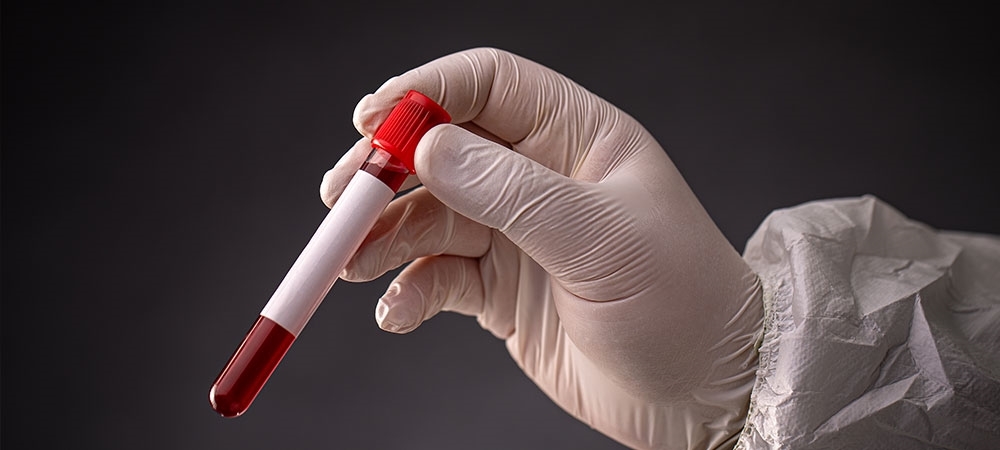 Amilaz yüksekliği ne anlama gelir? Amilaz kaç olursa tehlikeli?