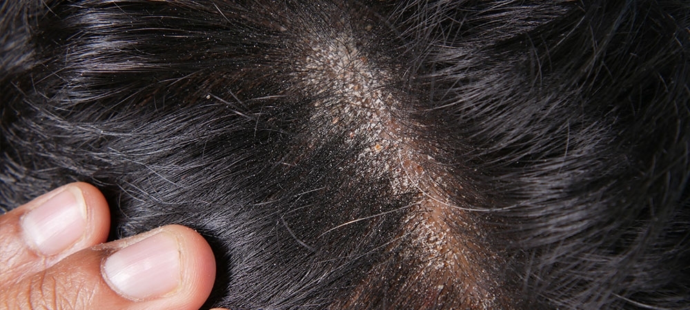 Kepek neden olur? Saçtaki kepek nasıl yok edilir?