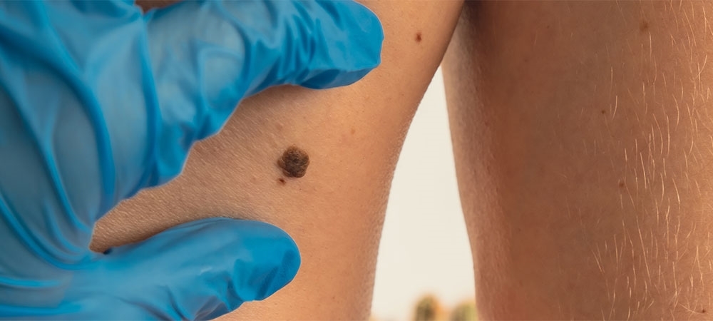 Cilt kanseri belirtileri nelerdir? Cilt kanseri en çok nerelerde görülür?