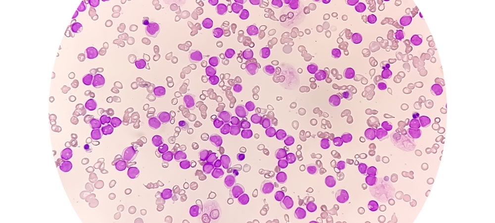 Lenfosit nedir? LYM düşüklüğü/ yüksekliği neden olur?