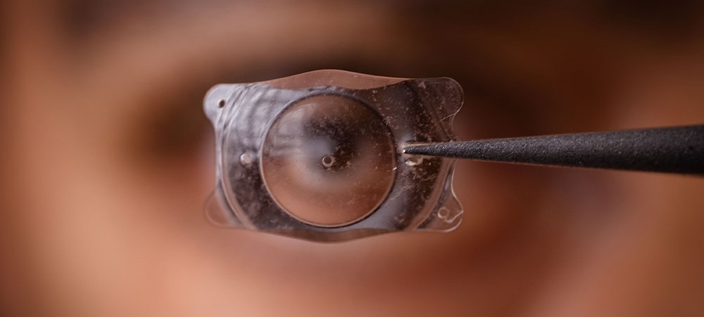 Relex (Smile) lazer nedir? Smile lazer kimlere uygulanır?