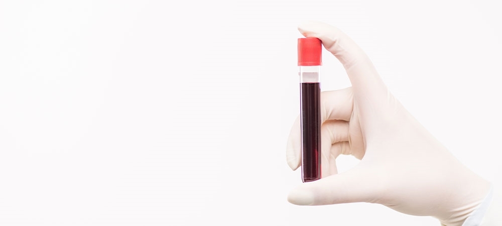 aPTT nedir? aPTT yüksekse ne yapılmalı?