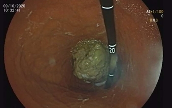 Aşırı Alıç tüketen 5 kişi hastanelik oldu