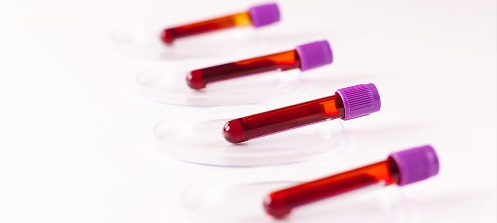 Kreatin kinaz nedir? Kreatin kinaz yüksek olursa ne olur?