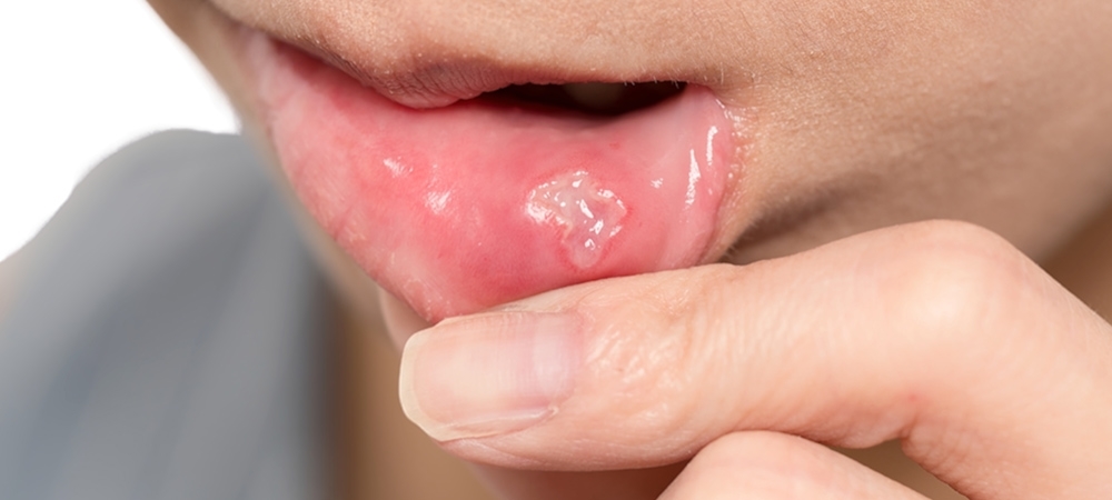 Aft niye çıkar? Afta ne iyi gelir?