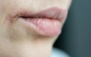 Ağız yarası nasıl geçer? Ağız yarasına ne iyi gelir?