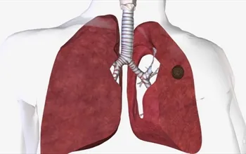 Akciğerde kitle nedir? Akciğerde kitle belirtileri nelerdir?