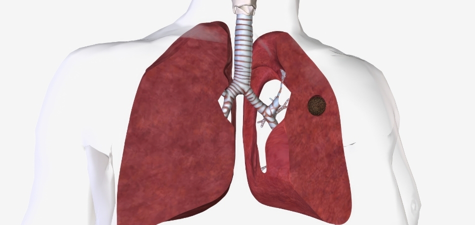 Akciğerde kitle nedir? Akciğerde kitle belirtileri nelerdir?