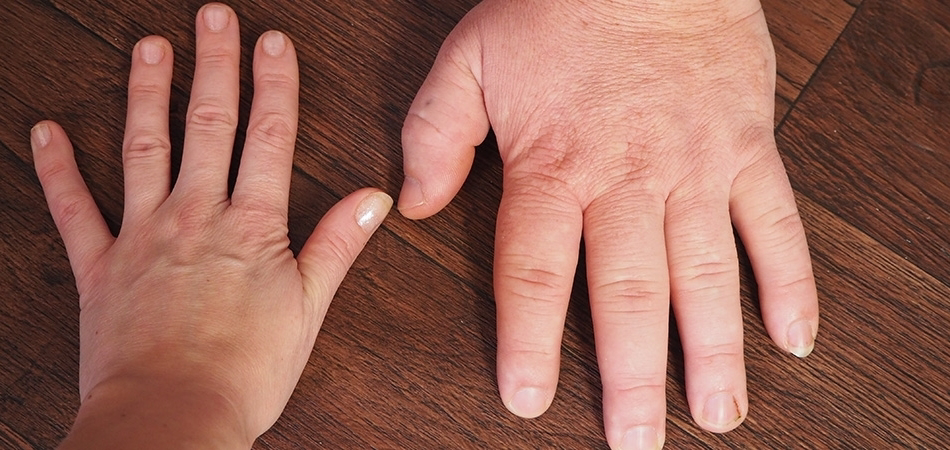 Akromegali: Büyüme hormonu fazlalığının belirtileri, tanısı ve tedavisi