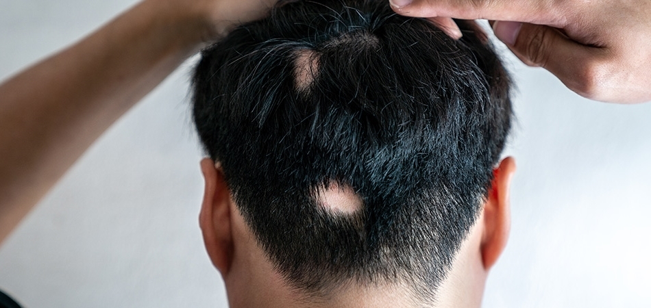 Alopesi areata nedir? Alopesi areata saçı geri gelir mi?