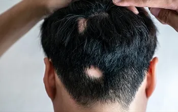 Alopesi areata nedir? Alopesi areata saçı geri gelir mi?
