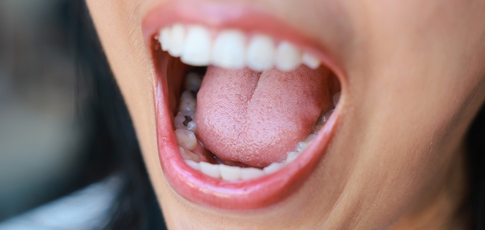 Amalgam dolgu nedir? Amalgam dolgu zararlı mı?