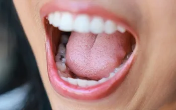 Amalgam dolgu nedir? Amalgam dolgu zararlı mı?