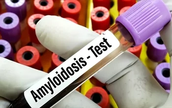 Amiloidoz: Nedenleri, belirtileri ve tedavi yaklaşımları
