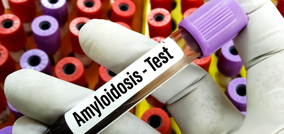 Amiloidoz: Nedenleri, belirtileri ve tedavi yaklaşımları