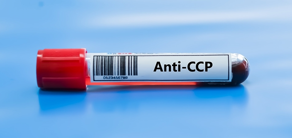 Anti-CCP: Nedir, ne zaman istenir ve sonuçlar nasıl yorumlanır?