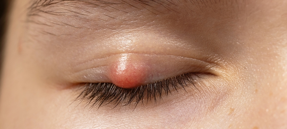 Arpacık nedir? Arpacık nasıl geçer?