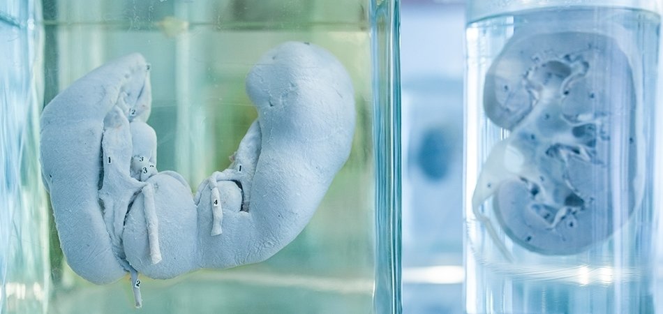 At nalı böbrek nedir? At nalı böbreğin belirtileri nelerdir?