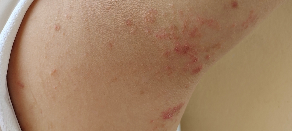 Atopik cilt nedir? Atopik cildin belirtileri nelerdir?