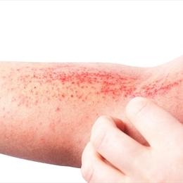 Atopik Dermatit