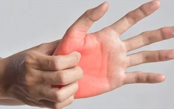 Avuç içi kaşıntısı neden olur? Avuç içi kaşıntısı neyin belirtisidir?