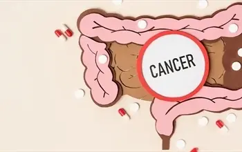Kolon kanserinin belirtileri nelerdir? Kolon (bağırsak) kanseri nedenleri, tedavisi...