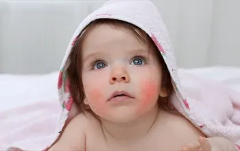 Bebeklerde alerji belirtileri nelerdir? Bebeklerde alerji nasıl anlaşılır?