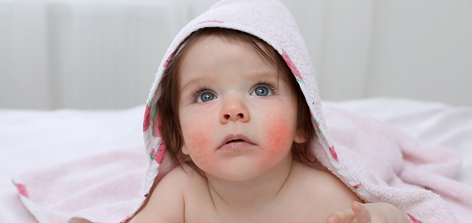 Bebeklerde alerji belirtileri nelerdir? Bebeklerde alerji nasıl anlaşılır?