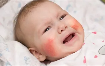 Bebeklerde egzama nedir? Bebeklerde egzama belirtileri nelerdir?