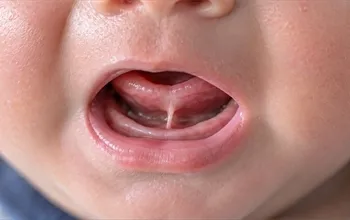 Bebekte dil bağı nedir? Belirtileri, tanı ve tedavi yaklaşımı