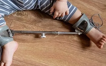 Bebekte kalça gelişim displazisi nedir?