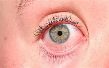 Behçet hastalığı göz belirtileri: Tanı, klinik bulgular ve tedavi yaklaşımları