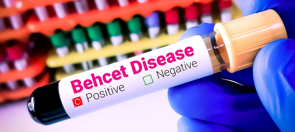Behçet hastalığı nedir? Behçet hastalığı neden olur?