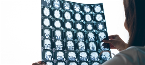 Beyin tümörü nedir? Beyin tümörü belirtileri nelerdir?