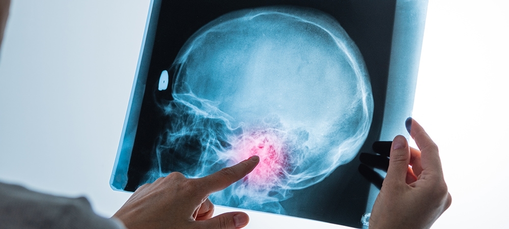 Beyin tümörü: Nedir, belirtileri nelerdir? Beyin tümörü tedavisi