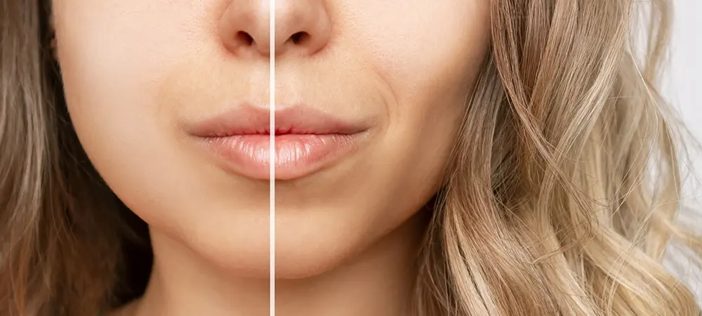 Bişektomi nedir? Bişektomi nasıl yapılır? Bişektomi nedir? Bişektomi nasıl yapılır?