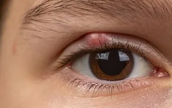 Blefarit nedir? Göz kapağı enfeksiyonu belirtileri nelerdir?