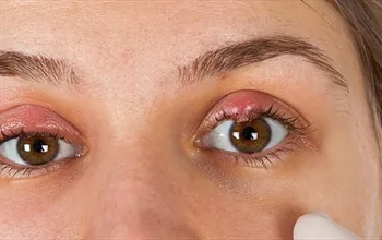 Blefarit nedir? Türleri, nedenleri ve tedavisi…