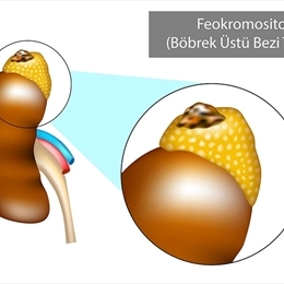 Böbrek Üstü Bezi Tümörü (Feokromositoma) Nedir?
