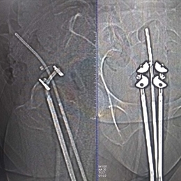 Kanserde Tanı ve Tedavi Yöntemleri - Radyasyon Onkolojisi - Brakiterapi