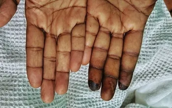 Buerger hastalığı ve sigara ile ilişkisi: Nedenleri, belirtileri ve tedavi yaklaşımı