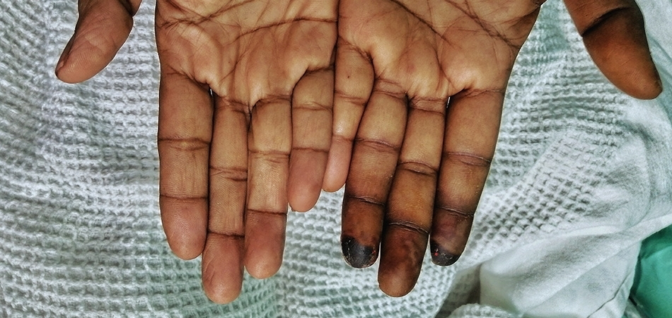 Buerger hastalığı ve sigara ile ilişkisi: Nedenleri, belirtileri ve tedavi yaklaşımı