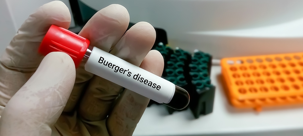 Buerger hastalığı nedir? Buerger hastalığı neden olur?