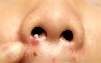 Burun içinde sivilce: Nedenleri, belirtileri ve tedavi yöntemleri