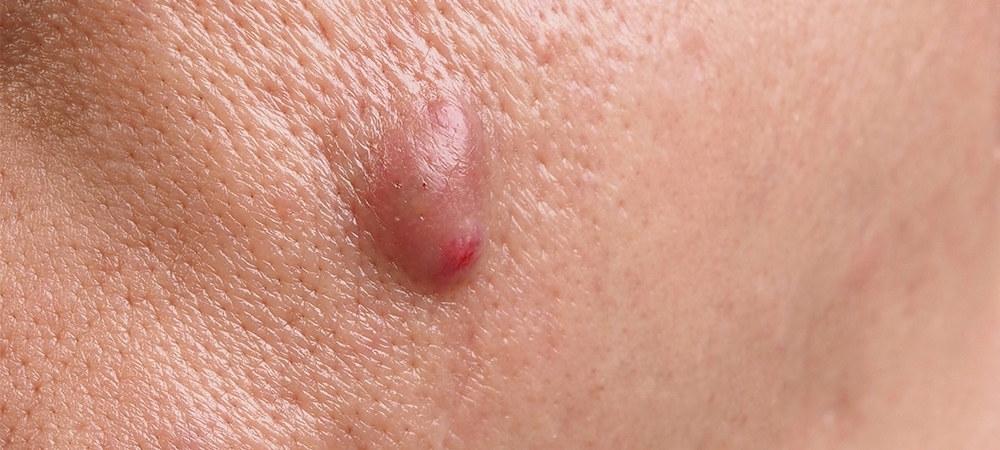 Çıban neden çıkar? Çıban nasıl geçer?